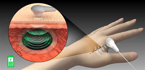  Titanogranaat: Revolutionerende Materialen voor de Toekomst van Batterijen en Biomedische Implanten!